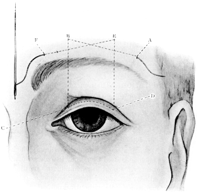 Harman’s Operation for Ptosis