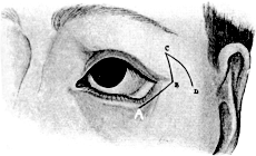 Denonvillier’s Operation for Ectropion of the Lower Lid