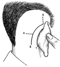 Diagram showing Position of Skin Incisions in Post-aural Operations
