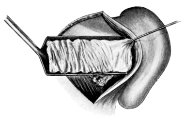 Skin-grafting of Mastoid Wound Cavity after Operation.