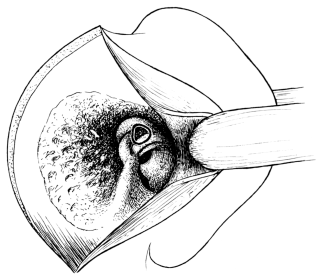 Diagram to show Exposure of the Semicircular Canals.