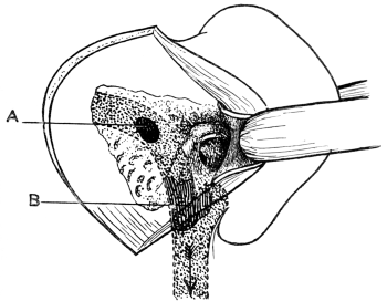 Diagram to show the usual Points at which the Lateral Sinus is primarily infected