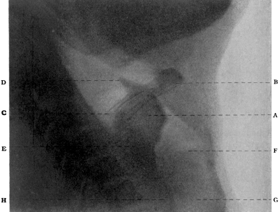 Skiagram showing a Tumour of the Larynx