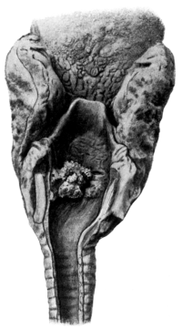 Multiple Papillomata of the Larynx