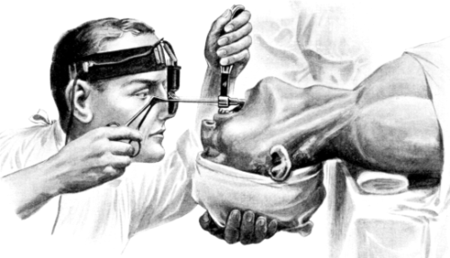 Removal of Multiple Papillomata by Direct Laryngoscopy