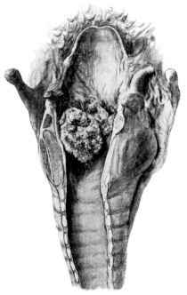 Intrinsic Tumour of the Larynx