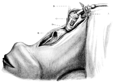Total Laryngectomy. Gluck’s Method.