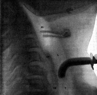 Skiagram showing an Angular Tracheotomy Tube in the Trachea