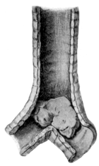 Sarcoma of the Trachea