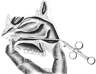 Amputation of the Posterior End of the Inferior Turbinal