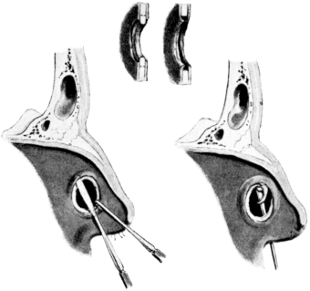 Operation for Perforation of the Septum