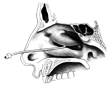 Catheterizing the Maxillary Sinus