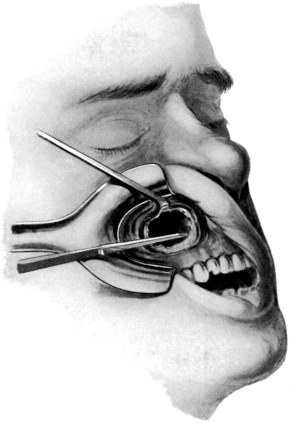 The Caldwell-Luc Operation upon the Maxillary Sinus