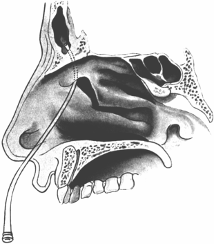 Catheterizing the Frontal Sinus