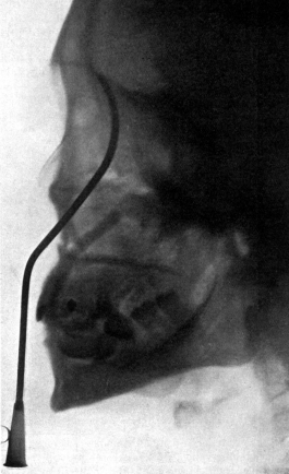 Radiograph to show the Value of the Röntgen Rays