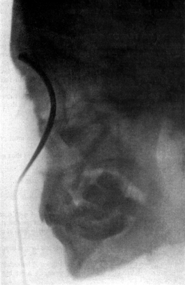 Radiograph showing Canula in the Frontal Sinus