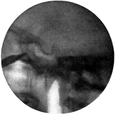 Radiograph of the Sphenoidal Sinus