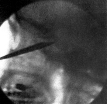 Radiograph of the Sphenoidal Sinus