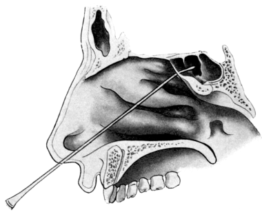 Catheterizing the Sphenoidal Sinus