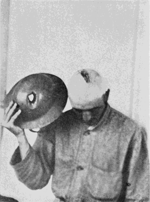 SERGT.
NICHOLSON, SHOWING HIS WOUNDED SKULL AND HELMET WORN WHEN WOUND WAS
RECEIVED