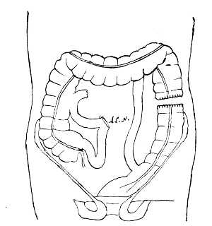 Diagram of the lower bowel, after a third operation.