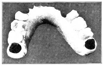 Upper denture in ivory