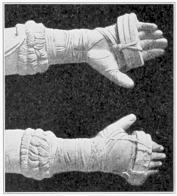 Forearm with Glove.