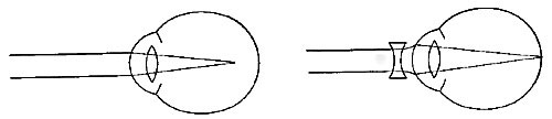 FIG. 81.—The nearsighted eye. The defect is remedied by concave glasses.
