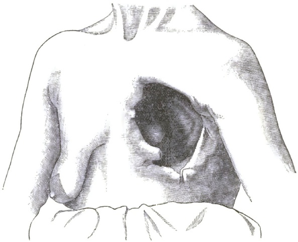 Aperture in the thoracic wall