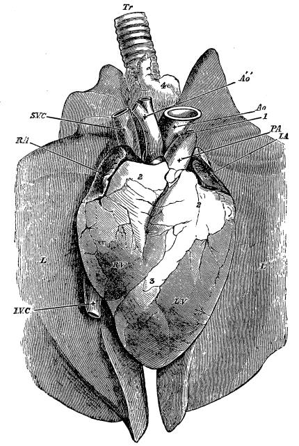 Image unavailable: Fig. 5.—Heart of Sheep, as seen after Removal from the Body, lying upon the Two Lungs. The Pericardium has been cut away, but no other Dissection made.  R.A. Auricular appendage of right auricle; L.A. auricular appendage of left auricle; R.V. right ventricle; L.V. left ventricle; S.V.C. superior vena cava; I.V.C. inferior vena cava; P.A. pulmonary artery; Ao, aorta; Áó, innominate branch from aorta dividing into subclavian and carotid arteries; L. lung; Tr. trachea. 1, solid cord often present, the remnant of a once open communication between the pulmonary artery and aorta. 2, masses of fat at the bases of the ventricle hiding from view the greater part of the auricles. 3, line of fat marking the division between the two ventricles. 4, mass of fat covering the trachea.