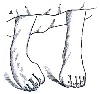 Feet in acute myelitis