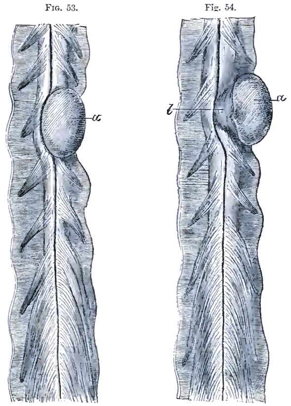 Psammoma of dorsal cord