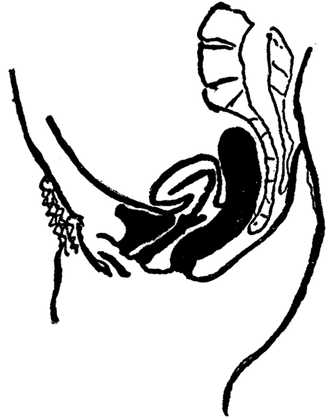 Anteflexion of the Uterus