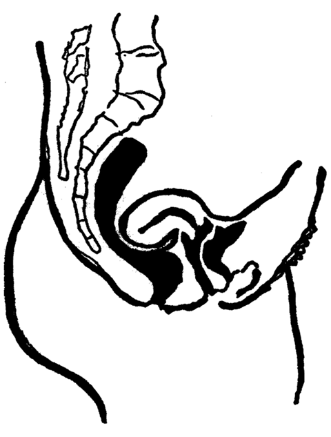 Retroflexion of the Uterus