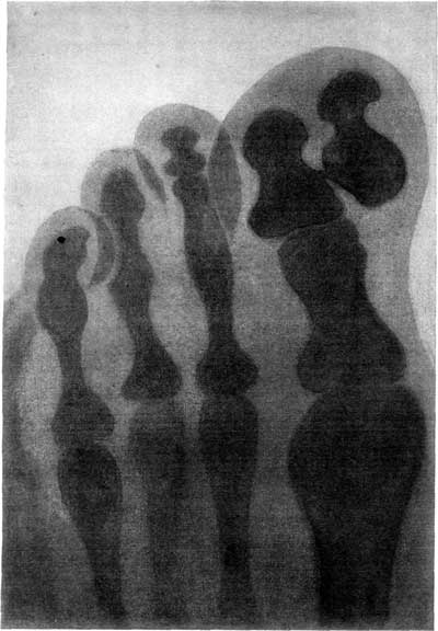 FIGURE 2.—SKIAGRAPH OF A FOOT, SHOWING AN EXTRA BONE IN THE GREAT TOE.