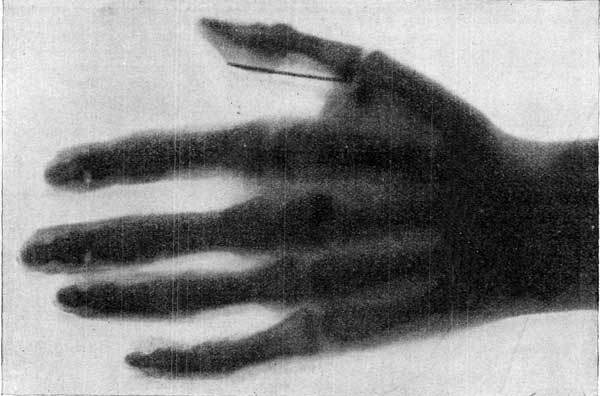 FIGURE 6.—SKIAGRAPH OF A DEAD HAND AND WRIST.