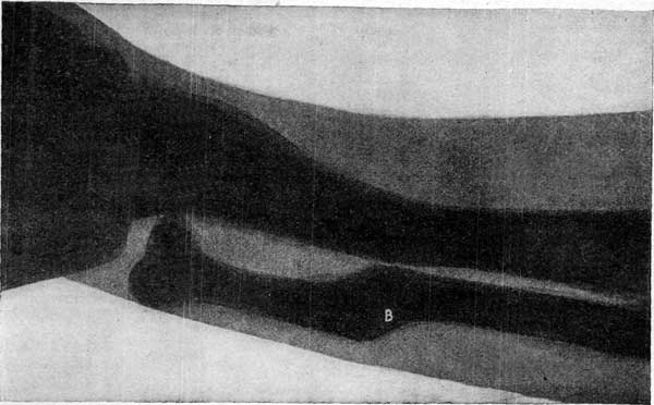 FIGURE 8.—SKIAGRAPH OF THE LEFT FOREARM OF A LIVING SUBJECT.