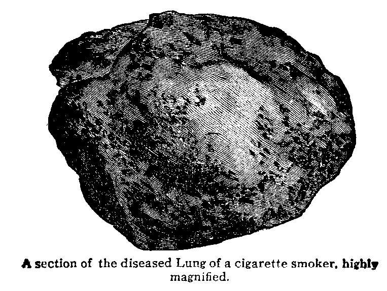 Line Drawing of a Diseased Lung