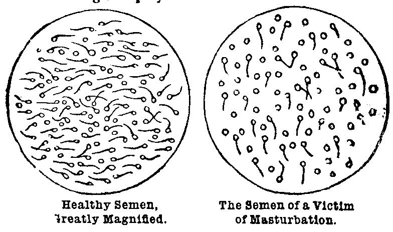Healthy Semen, Greatly Magnified and The Semen of a Victim of Masturbation
