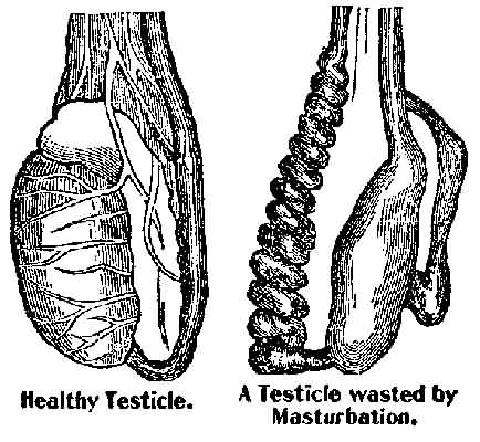 Left, Healthy Testicle and Right, A Testicle Wasted by Masturbation