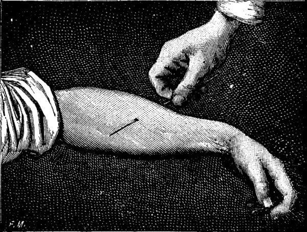 FIG. 4.—AN ARM TRANSPIERCED BY A NEEDLE.