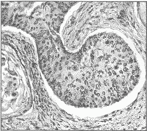Fig. 14—Photograph Of A Microscopic Preparation From A Cancer Of The Uterus. A large mass of cells is extending into the tissue of the uterus which is shown as the fibrous structure. Such a cell mass penetrating into the tissue represents the real cancer, the tissue about the cell masses bear the blood vessels which nourish the tumor cells.