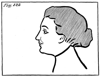 Figure 125: Helen Keller with her eyes opened.