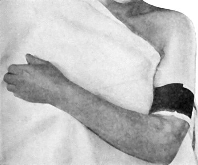 Fig. 6.—Passive Hyperæmia of Hand and Forearm induced by Bier's Bandage.