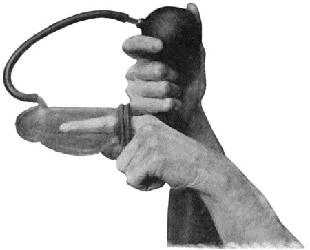 Fig. 7.—Passive Hyperæmia of Finger induced by Klapp's Suction Bell.