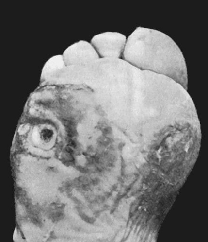 Fig. 15.—Perforating Ulcers of Sole of Foot. (From Photograph lent by Sir Montagu Cotterill.)