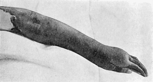 Fig. 21.—Embolic Gangrene of Hand and Arm.