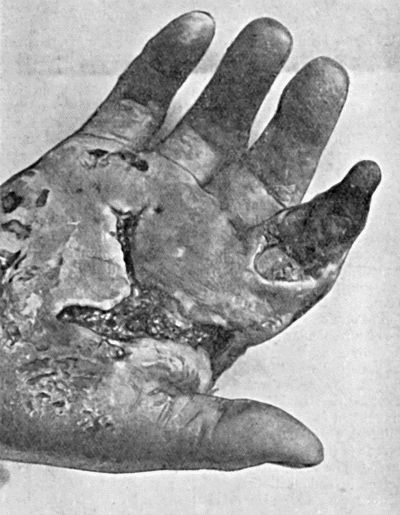 Fig. 22.—Gangrene of Terminal Phalanx of Index-Finger, following cellulitis of hand resulting from a scratch on the palm of the hand.
