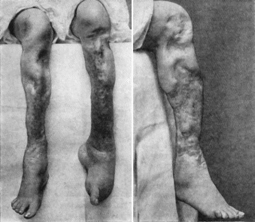 Fig. 41.—Ulceration of nineteen year's duration in a woman æt. 24, the subject of inherited syphilis, showing active ulceration, cicatricial contraction, and sabre-blade deformity of tibiæ.