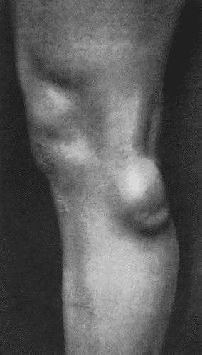 Fig. 61.—Ganglion on lateral aspect of Knee in a young woman.